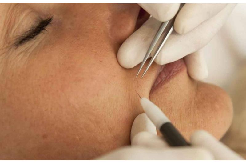 Ni�anta�� ��neli Epilasyon